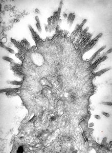 M,18y. | immotile cilia syndrome - bronchus - microvillous prominence M,18y. | immotile cilia syndrome - bronchus - microvillous prominence